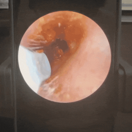 AudiPro - Nettoyant d'oreilles avec caméra HD intégrée